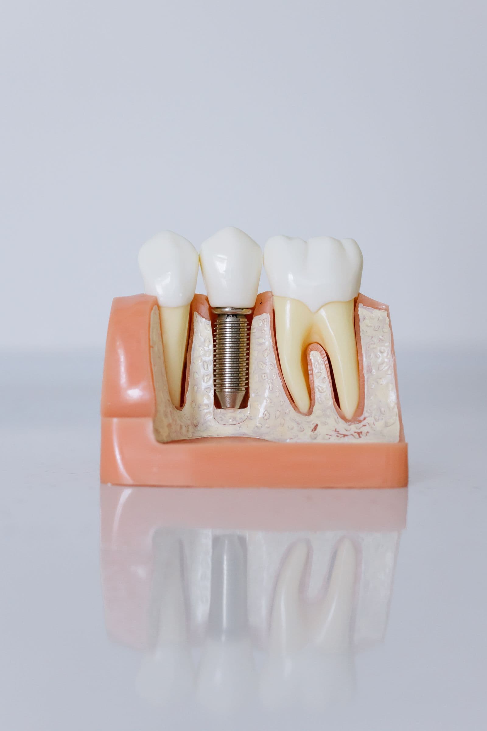 Teaching model of a dental implant between two natural tooth roots